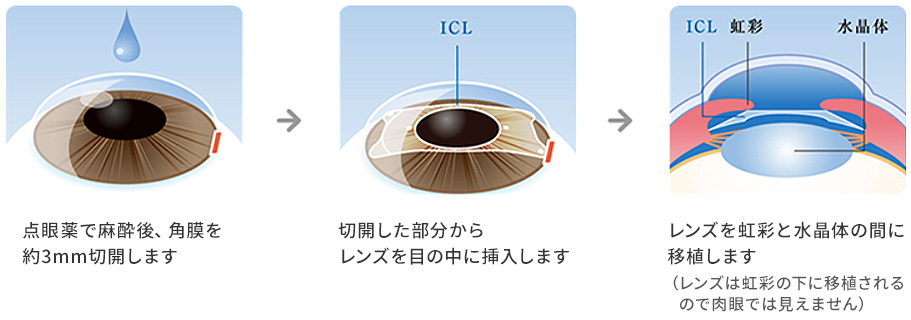 ICL手術の実際